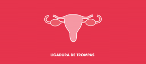 Ligadura de Trompas